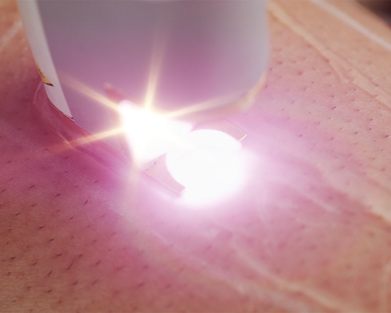laser hair removal